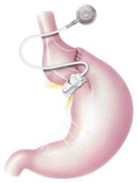 gastric-banding-img-melbourne-gastro-oesophageal