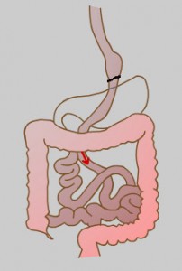 gastric1